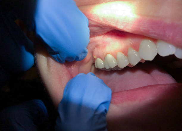 Best Emergency Dental Extractions in Barrington, NJ